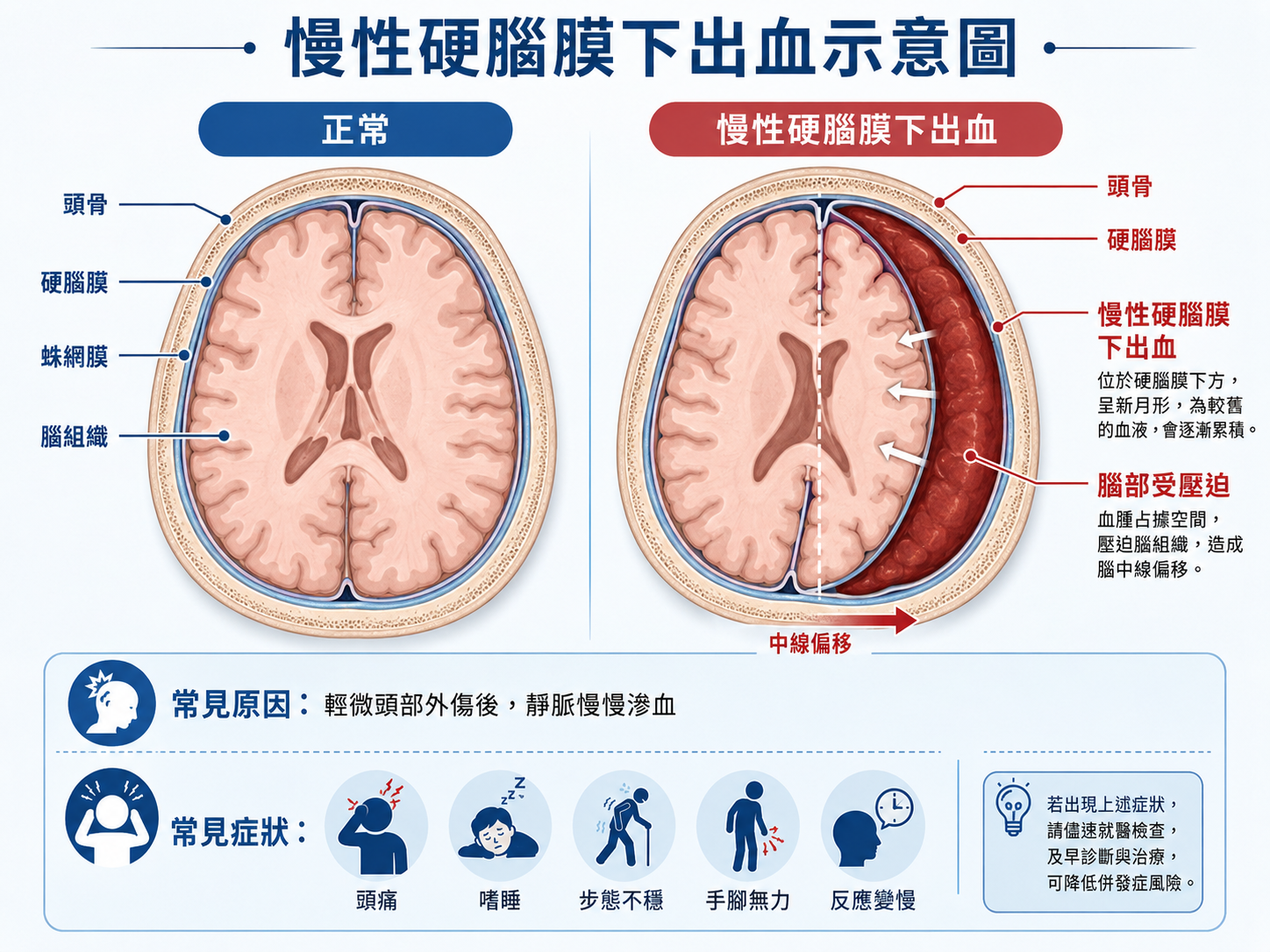 慢性硬腦膜下出血與正常腦部對照示意圖